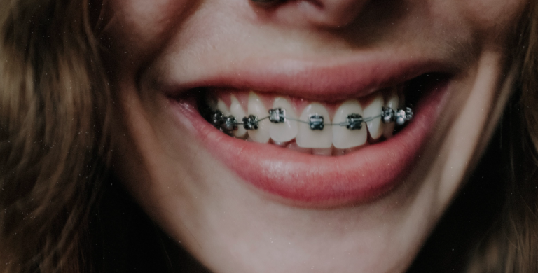 Quanto Costa un Apparecchio Dentale per Adulti? Guida Completa