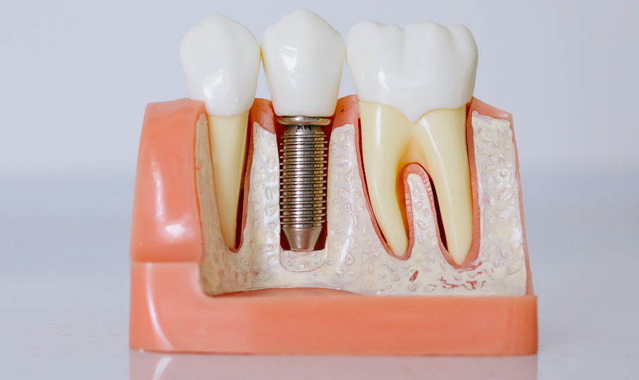 Come si Attacca il Dente all’Impianto Dentale