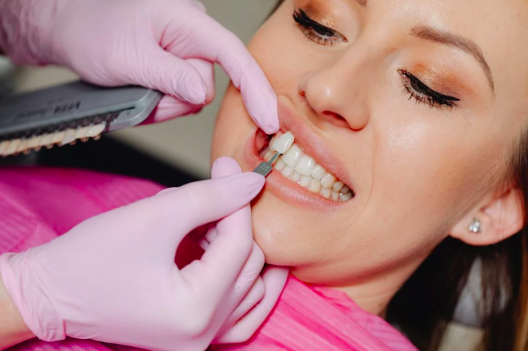 Faccette dentali: come avviene l’applicazione