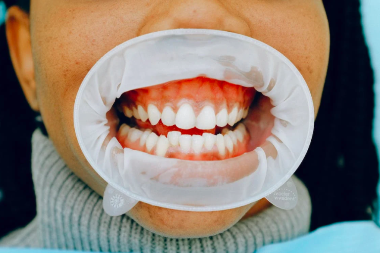 Infiammazione Gengive: Gengive infiammate rimedi e cause infiammazione gengive