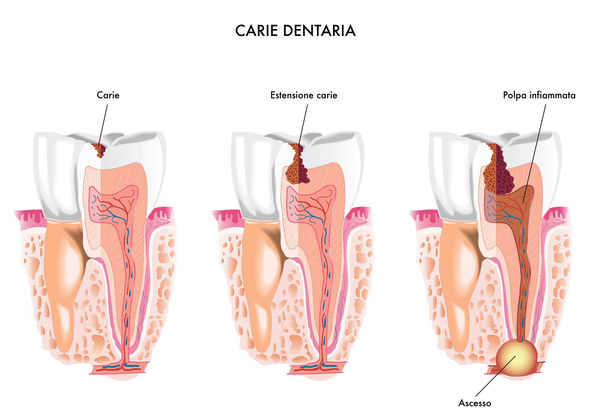 cure carie