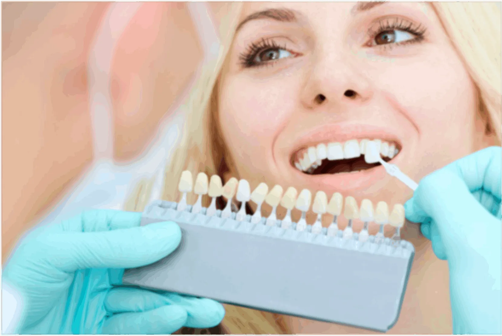 A cosa servono le faccette dentali?