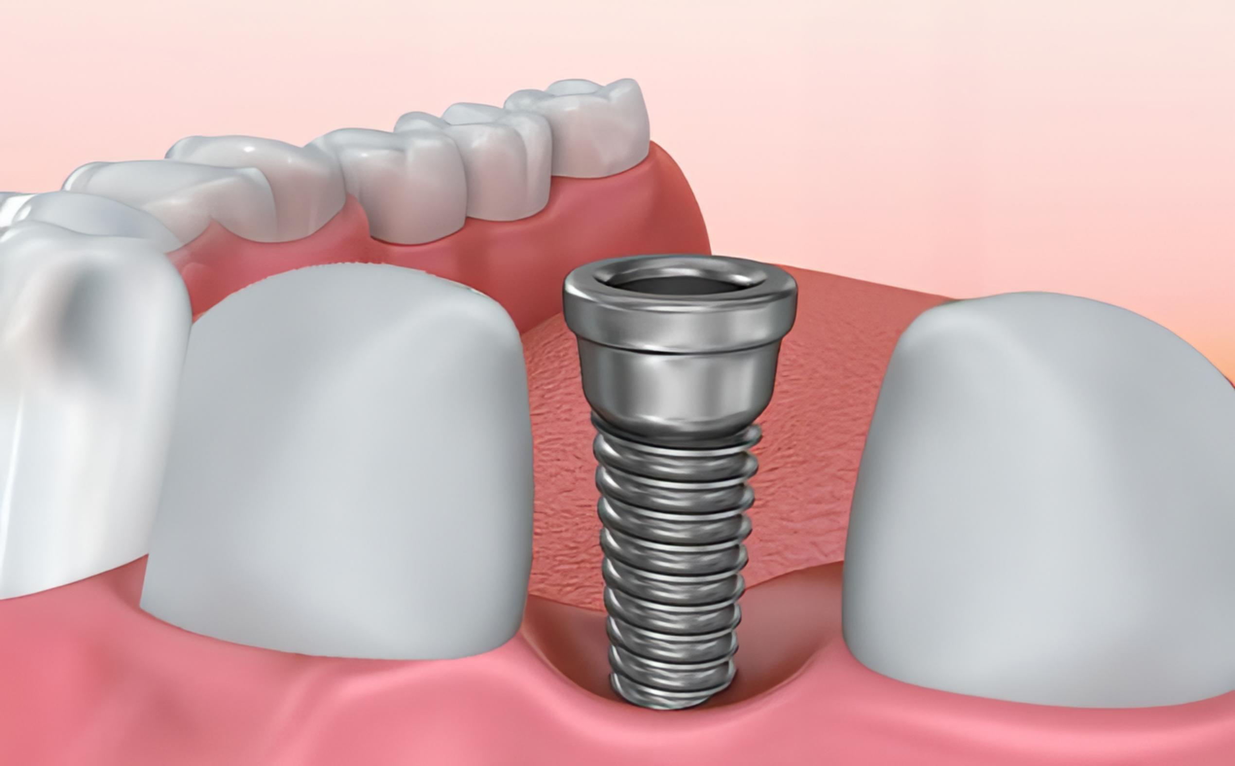 Come è composto un impianto dentale?