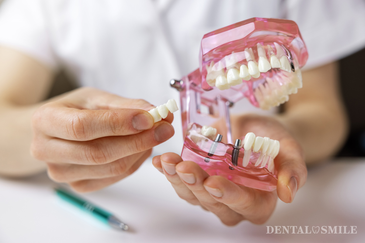 corone dentali