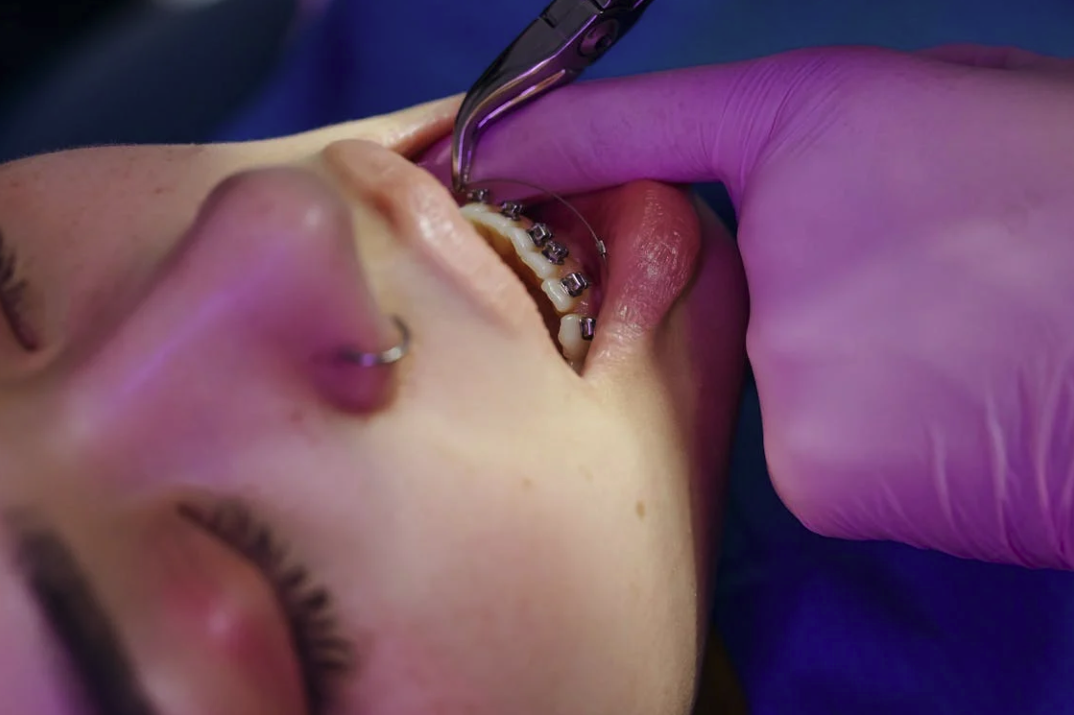 Elastici apparecchio: Quanto tempo si portano gli elastici ortodontici? 1 Elastici apparecchio: Quanto tempo si portano gli elastici ortodontici?